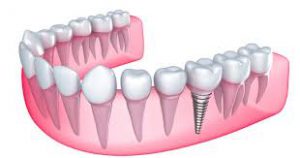 ایمپلنت دندانی