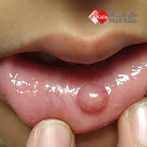 دلیل بیماری لب