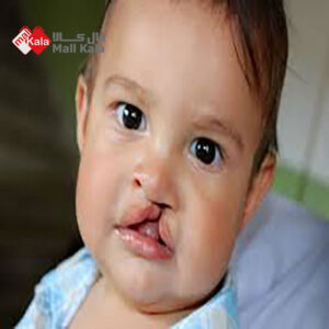 انواع سندروم یا نشانگان