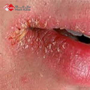 درمان بیماری لب