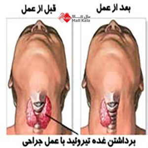 عمل غده تیروئید