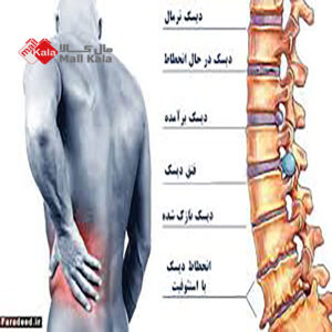 درمان کمردرد
