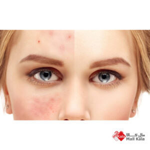 ترکاندن جوش های صورت