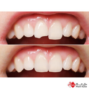 ترک خوردن دندان