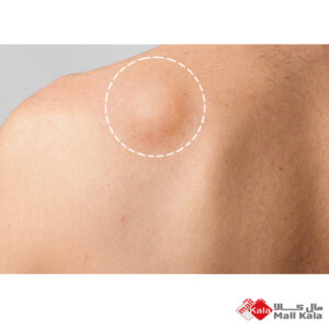 غده چربی لیپوما