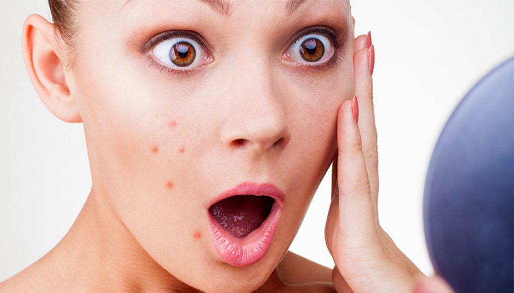 ترکاندن جوش های صورت