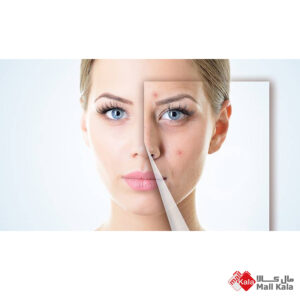 ترکاندن جوش های صورت