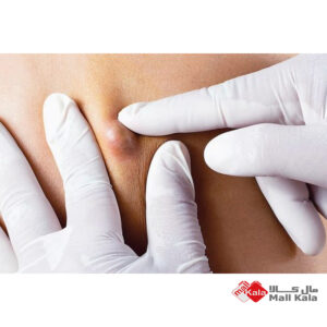 غده چربی لیپوما